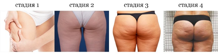 Làm thế nào để loại bỏ cellulite trên chân và dưới cùng. Bài tập trong tuần, chương trình đào tạo dành cho nữ