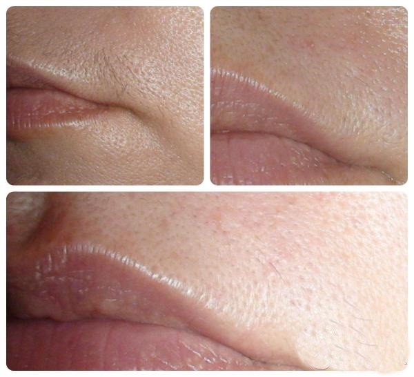 Rambut laser menghilangkan bibir atas (antena) pada wanita. Berapa banyak sesi yang diperlukan, bagaimana ia dilakukan
