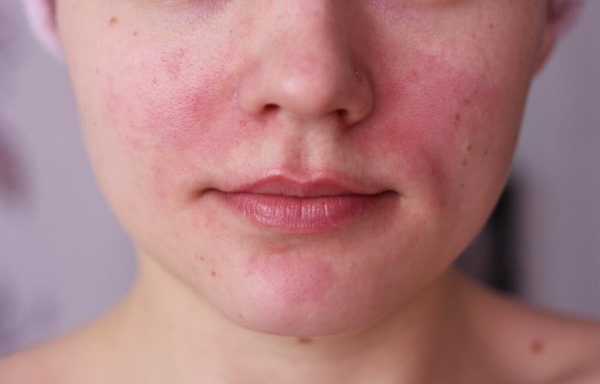Rambut laser menghilangkan bibir atas (antena) pada wanita. Berapa banyak sesi yang diperlukan, bagaimana ia dilakukan
