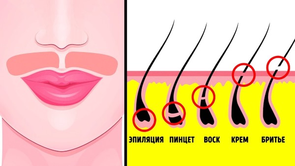 Rambut laser menghilangkan bibir atas (antena) pada wanita. Berapa banyak sesi yang diperlukan, bagaimana ia dilakukan