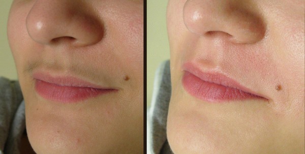 Rambut laser menghilangkan bibir atas (antena) pada wanita. Berapa banyak sesi yang diperlukan, bagaimana ia dilakukan