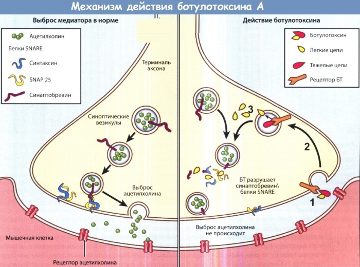 Како уклонити боре између обрва. Гипс, масти, креме, вежбе, масажа, ботокс