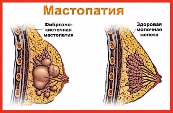 Phẫu thuật thu nhỏ tuyến vú. Căng da mặt giá bao nhiêu, các loại, cách thực hiện miễn phí