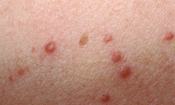 Papilomas no corpo feminino. Causas e tratamento, como se livrar dos remédios populares