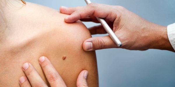 Papilomas no corpo feminino. Causas e tratamento, como se livrar dos remédios populares
