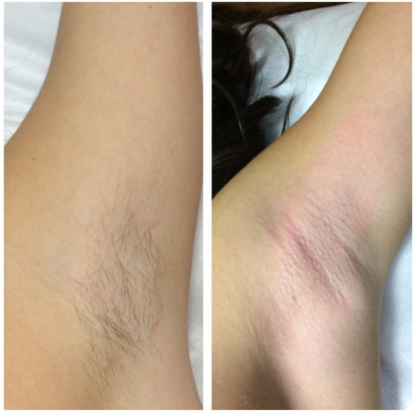 Shugaring là gì, bao lâu là đủ, cách chuẩn bị và tự làm. Công thức mì ống tự làm
