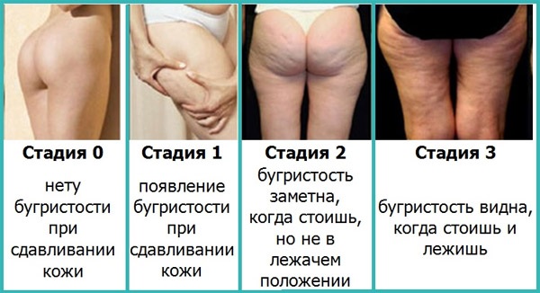 Cách massage giảm béo bụng và hai bên hông: hút chân không, Trung Quốc, chống cellulite nội tạng, dẫn lưu bạch huyết