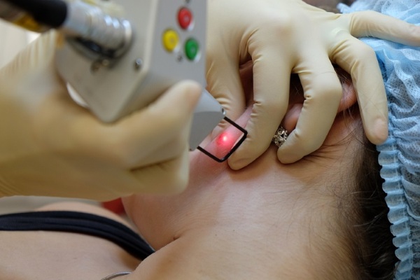 Laser loại bỏ khối u trên da, khối u, u nhú. Thủ tục ra sao, giá cả, đánh giá