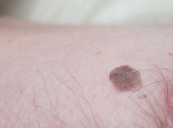 Laser loại bỏ khối u trên da, khối u, u nhú. Thủ tục ra sao, giá cả, đánh giá