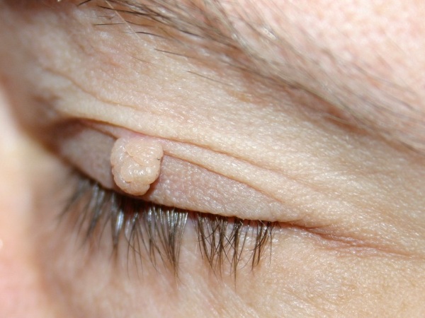 Laser loại bỏ khối u trên da, khối u, u nhú.Thủ tục ra sao, giá cả, đánh giá
