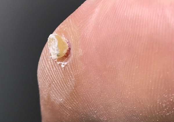 Laser loại bỏ khối u trên da, khối u, u nhú. Thủ tục ra sao, giá cả, đánh giá