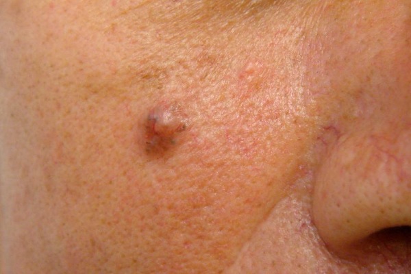 Laser loại bỏ khối u trên da, khối u, u nhú. Thủ tục ra sao, giá cả, đánh giá