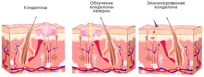 Laser loại bỏ khối u trên da, khối u, u nhú. Thủ tục ra sao, giá cả, đánh giá