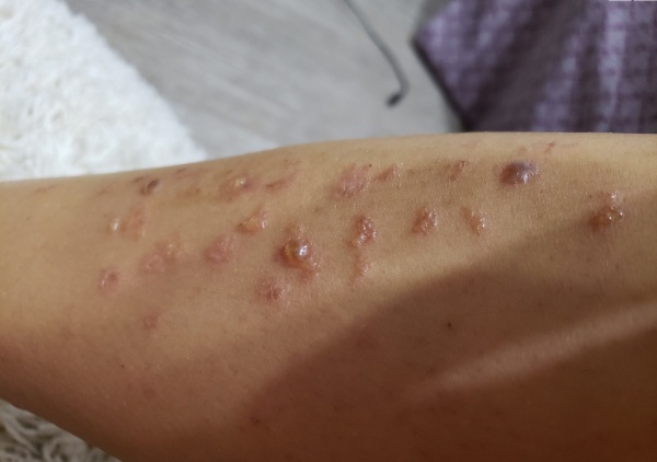 Laser loại bỏ khối u trên da, khối u, u nhú. Thủ tục ra sao, giá cả, đánh giá