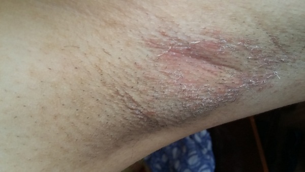 Algel para axilas. Instruções de uso, preço, análogos, comentários