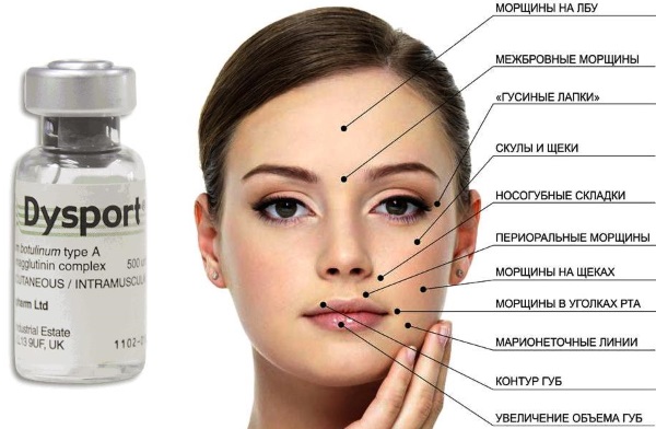 Dysport trong thẩm mỹ. Hình ảnh trước và sau khi sử dụng, nhận xét của bác sĩ thẩm mỹ và bệnh nhân, giá cả