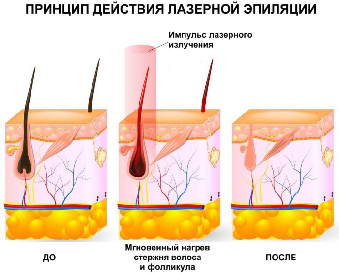 Како се трајно отарасити длака на лицу. Козметолошке методе код куће