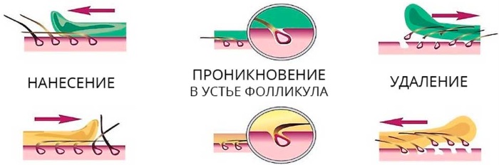 Како се трајно отарасити длака на лицу. Козметолошке методе код куће