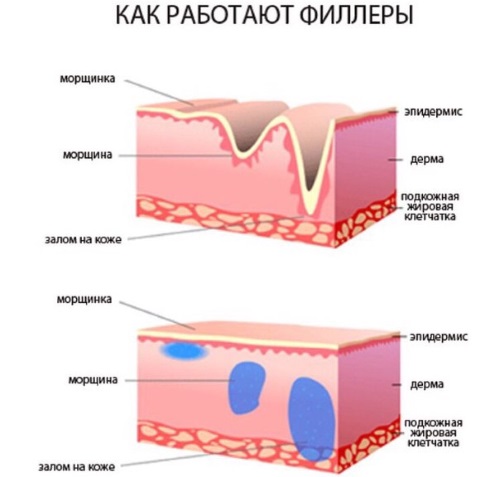 Контурна пластика назолакрималног жлеба. Пре и после фотографија, компликација, прегледа
