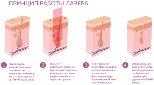 เลเซอร์นีโอดิเมียมสำหรับกำจัดขนบนใบหน้าและร่างกาย ก่อนและหลังภาพถ่ายราคาบทวิจารณ์