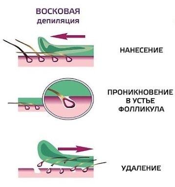 Полимерни восак за депилацију. Шта је то, који купити, како га користити
