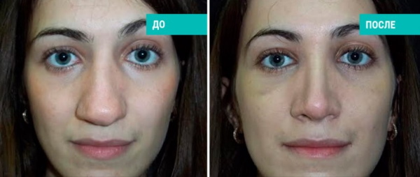 Gadis mempunyai hidung yang lebar. Apa yang perlu dilakukan, bagaimana menyingkirkan, rhinoplasty