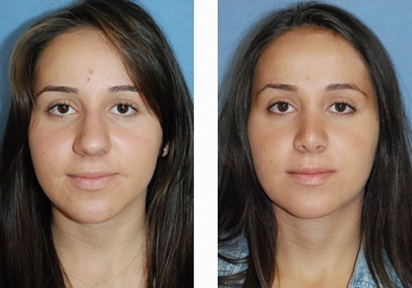 Gadis mempunyai hidung yang lebar. Apa yang perlu dilakukan, bagaimana menyingkirkan, rhinoplasty