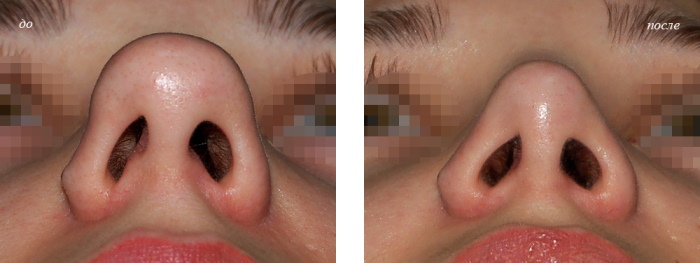 Gadis mempunyai hidung yang lebar. Apa yang perlu dilakukan, bagaimana menyingkirkan, rhinoplasty