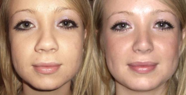 Gadis mempunyai hidung yang lebar. Apa yang perlu dilakukan, bagaimana menyingkirkan, rhinoplasty
