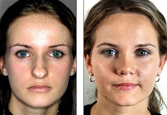 Gadis mempunyai hidung yang lebar. Apa yang perlu dilakukan, bagaimana menyingkirkan, rhinoplasty