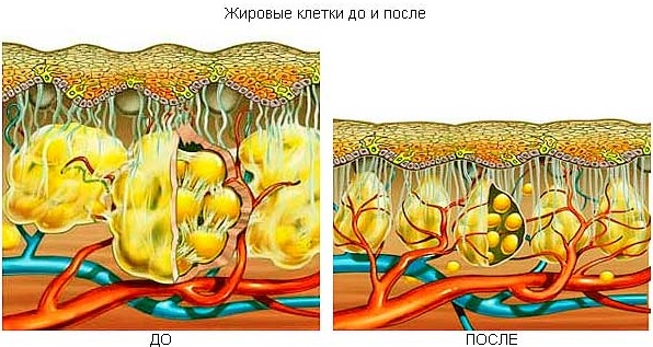 Лекови против целулита. Обмотајте рецепте, пилинге, вежбе, креме, масажу код куће
