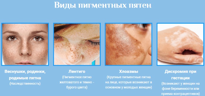 Брзо уклоните пигментацију са лица код куће. Креме, народни лекови