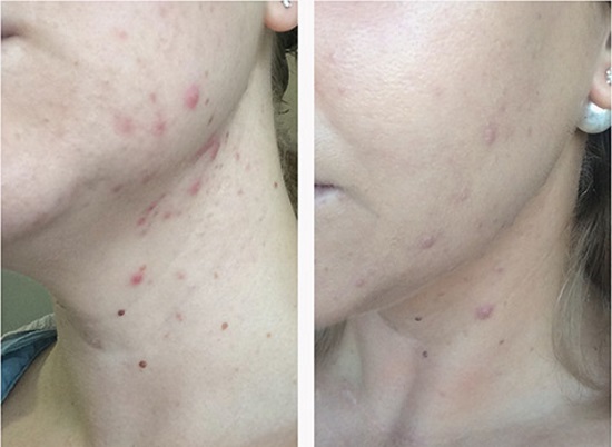 Azelaic حامضي. الاستعدادات ، تعليمات للاستخدام في التجميل