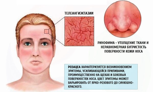 Azelaic حامضي. الاستعدادات ، تعليمات للاستخدام في التجميل