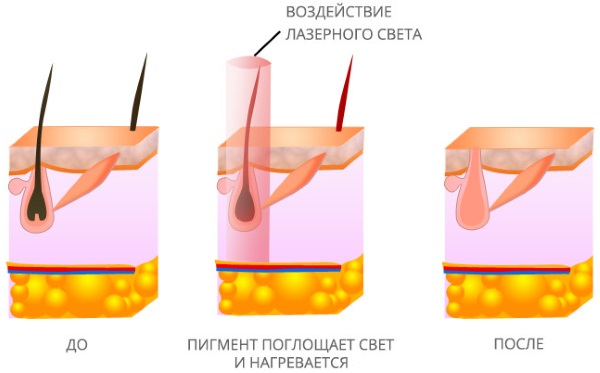 Tẩy lông / triệt lông tại nhà bằng sáp / đường / mật ong, shugaring. Cách làm, công thức nấu ăn