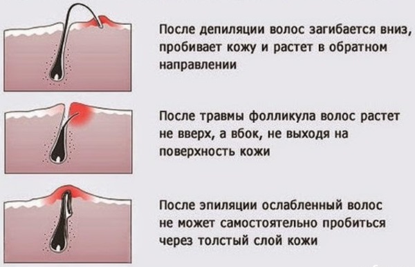 Tẩy lông / triệt lông tại nhà bằng sáp / đường / mật ong, shugaring. Cách làm, công thức nấu ăn