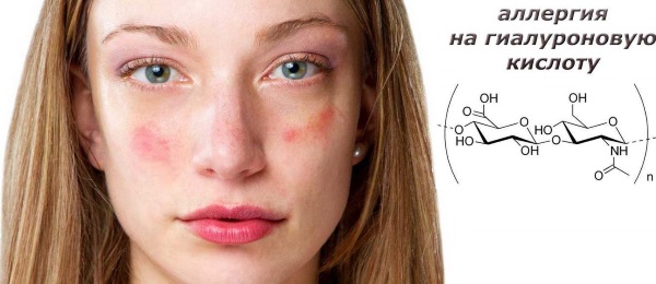 نحت الوجه بالحشو. صورة لكيفية إجراء التصحيح البيضاوي ، والنمذجة ، والشد ، والتعزيز