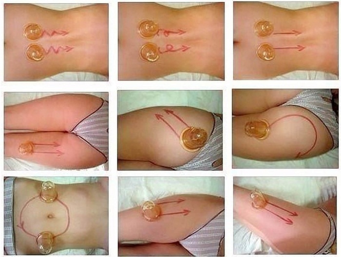 Massage chân không với lon cho cellulite trên bụng và hai bên. Hình ảnh, đánh giá, cách làm đúng