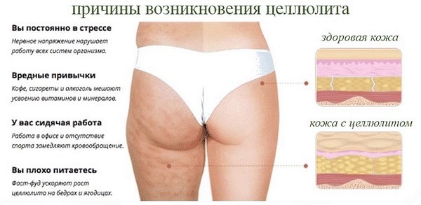 Máy mát xa cơ thể chống cellulite: bằng tay, bằng điện. Cái nào tốt hơn, đánh giá