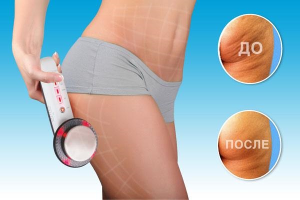 Máy mát xa cơ thể chống cellulite: bằng tay, bằng điện. Cái nào tốt hơn, đánh giá