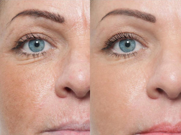 Mesotherapy quanh mắt trị thâm quầng, thâm, túi, phù nề. Ảnh trước và sau, giá cả, đánh giá