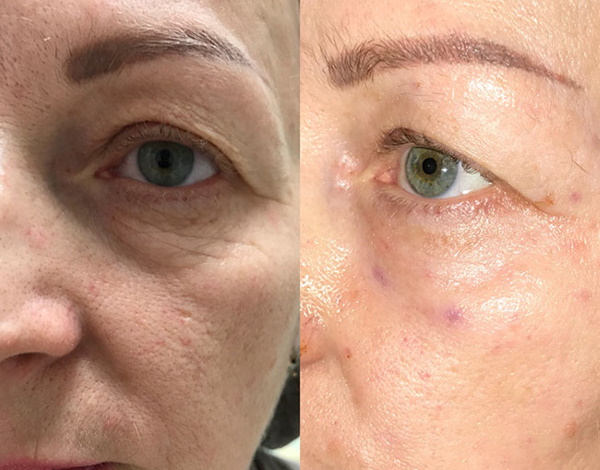 Mesotherapy quanh mắt trị thâm quầng, thâm, túi, phù nề. Ảnh trước và sau, giá cả, đánh giá