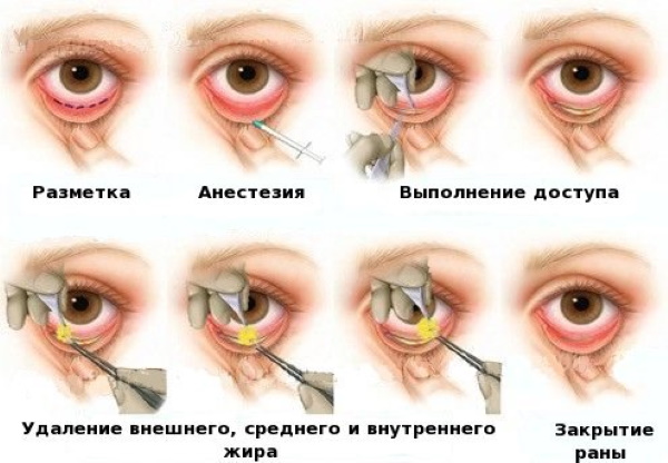Хируршко и нехируршко подизање капака. Кружна блефаропластика, месотреадс, ласер, боток. Фотографије, цене