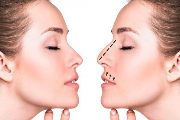 تجميل الأنف: مغلق ، مفتوح ، ترميمي ، حقن ، ليزر. السعر والاستعراضات