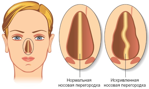 تجميل الأنف: مغلق ، مفتوح ، ترميمي ، حقن ، ليزر. السعر والاستعراضات