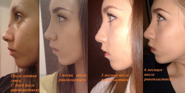 تجميل الأنف: مغلق ، مفتوح ، ترميمي ، حقن ، ليزر. السعر والاستعراضات