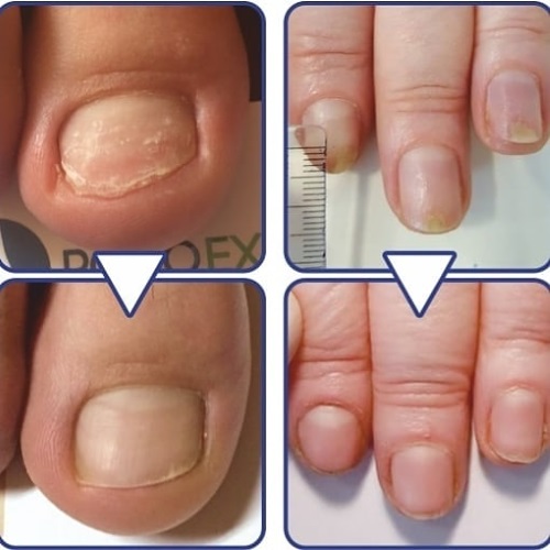 Serum Arcade para unhas. Como usar, análogos, comentários