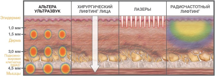 علاج Ulthera (Altera) في تجميل الأجهزة. قبل وبعد الصور والسعر والمراجعات
