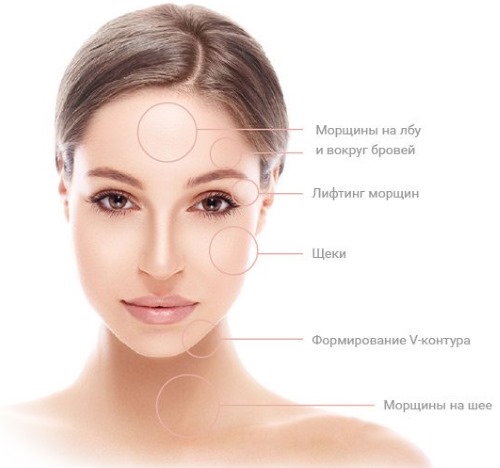 علاج Ulthera (Altera) في تجميل الأجهزة. قبل وبعد الصور والسعر والمراجعات