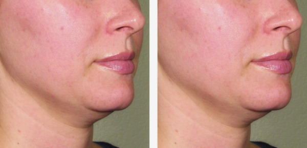 علاج Ulthera (Altera) في تجميل الأجهزة. قبل وبعد الصور والسعر والمراجعات